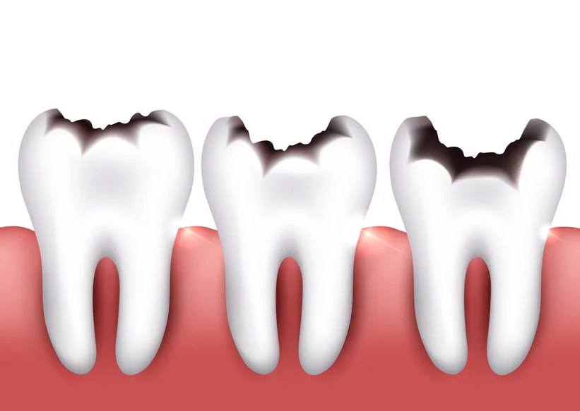 Tooth decay symptoms cavity sensitivity