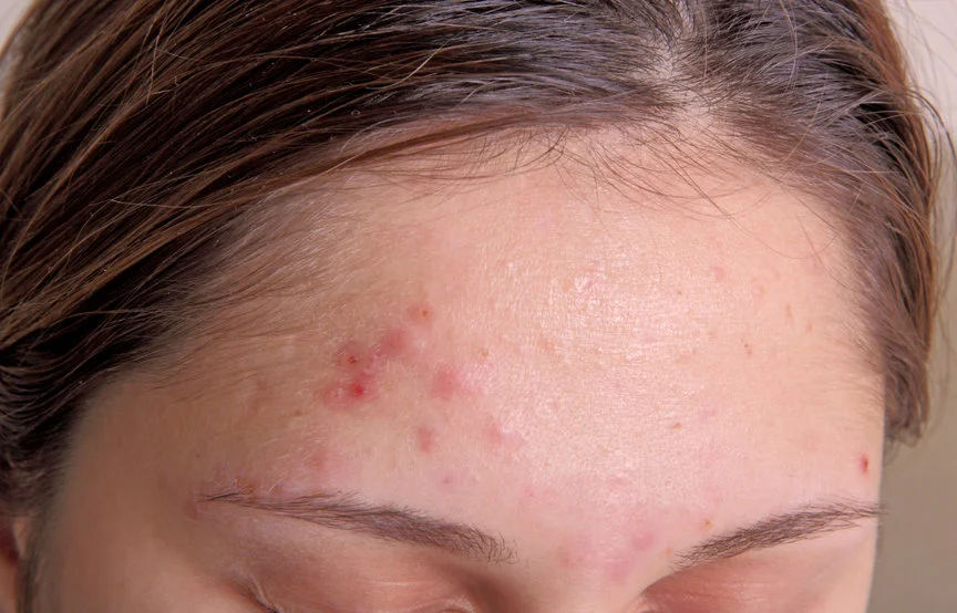 Acne symptoms spots types skin condition
