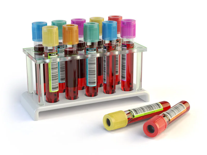 Amniocentesis sample sent for lab testing