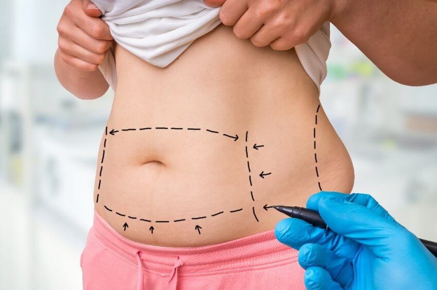 What is a Tummy Tuck
