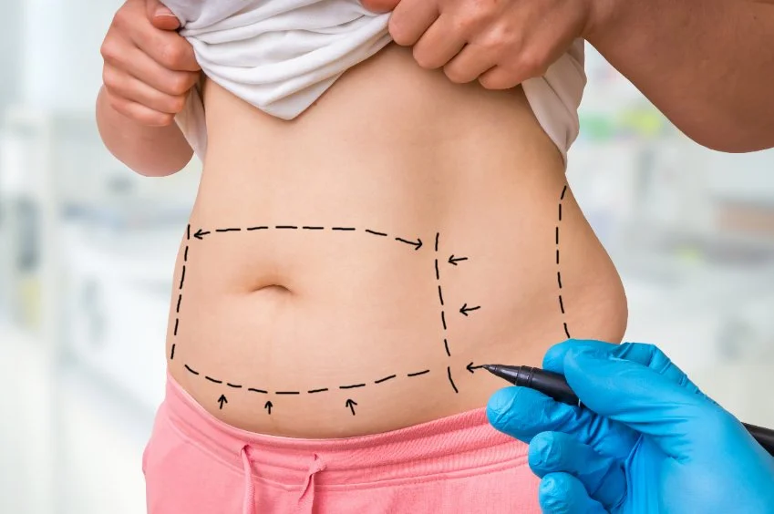 Tummy Tuck