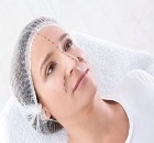What is Rhinoplasty?