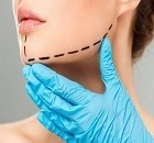 facelift surgery