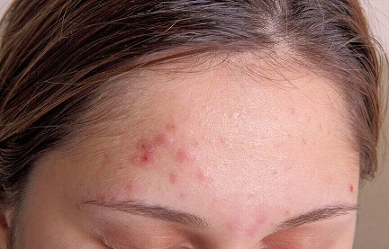 Acne Care