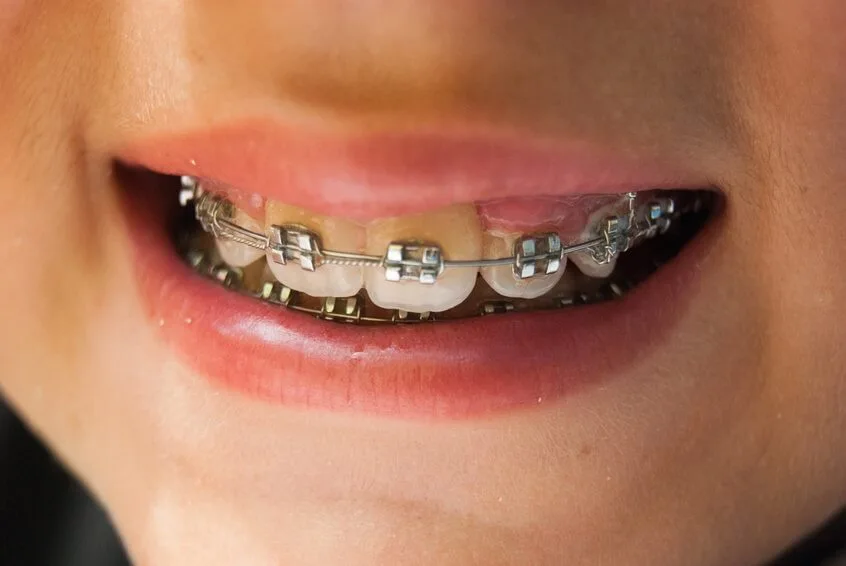 Dental braces and orthodontic treatment
