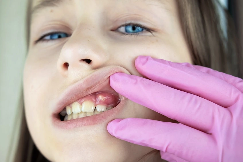 Dental abscess symptoms urgent dentist appointment